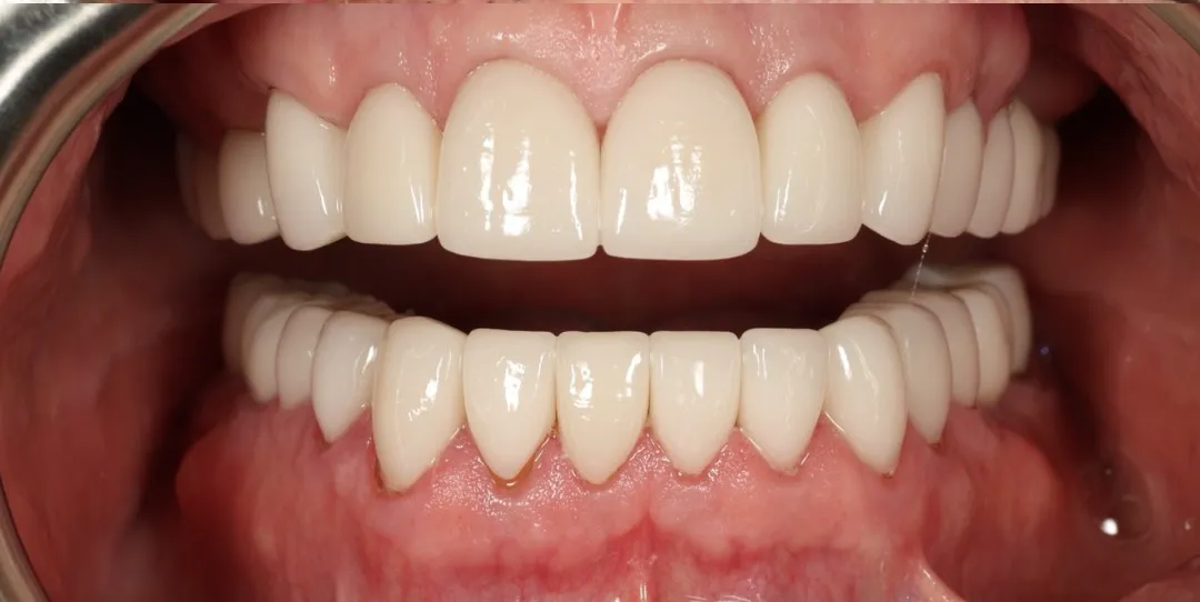 Before and after teeth restoration using biocompatible materials in biological dentistry in Florida.