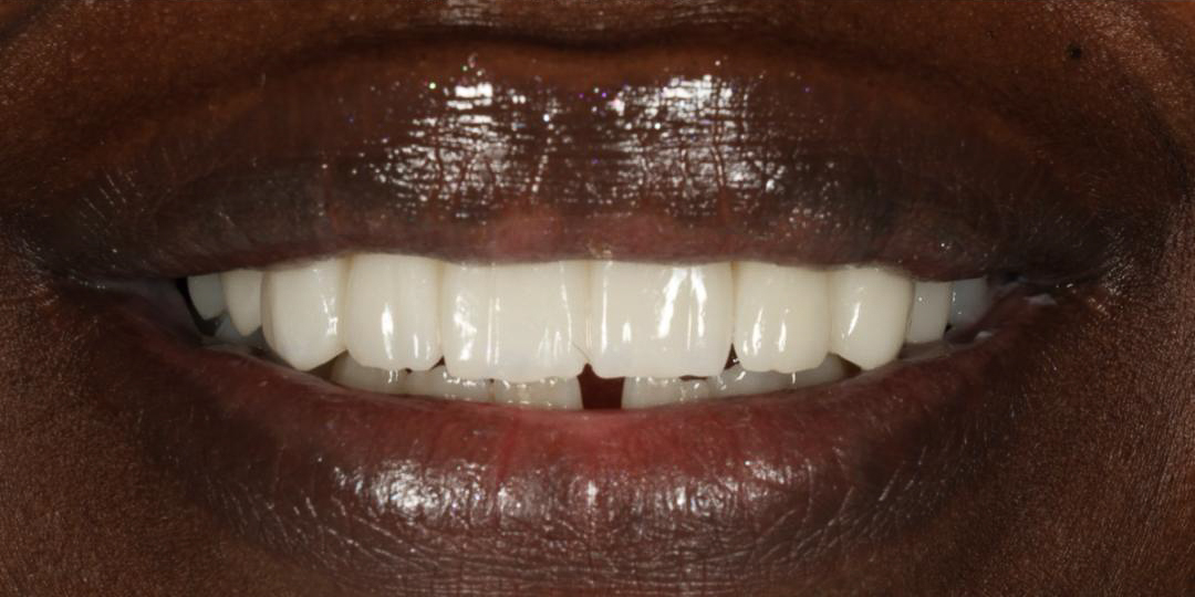 Before and after rehabilitation of lost teeth due to parafunctional habit by a biological dentist in Florida.
