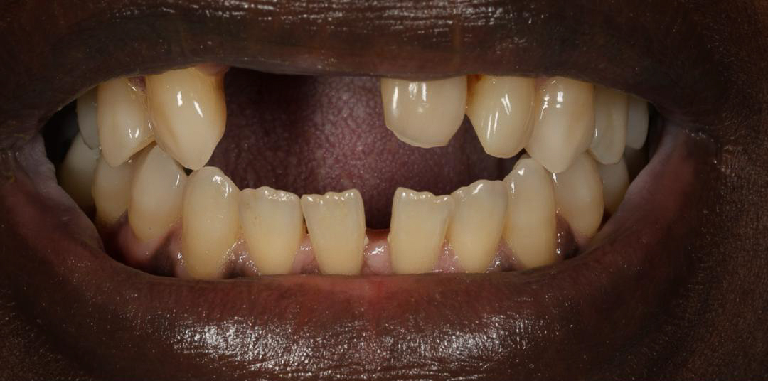 Before and after rehabilitation of lost teeth due to parafunctional habit by a biological dentist in Florida.
